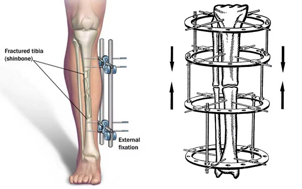 Deformity Correction